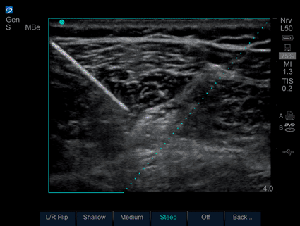 Image: An ultrasound image utilizing Advanced Needle Visualization (Photo  courtesy of SonoSite).